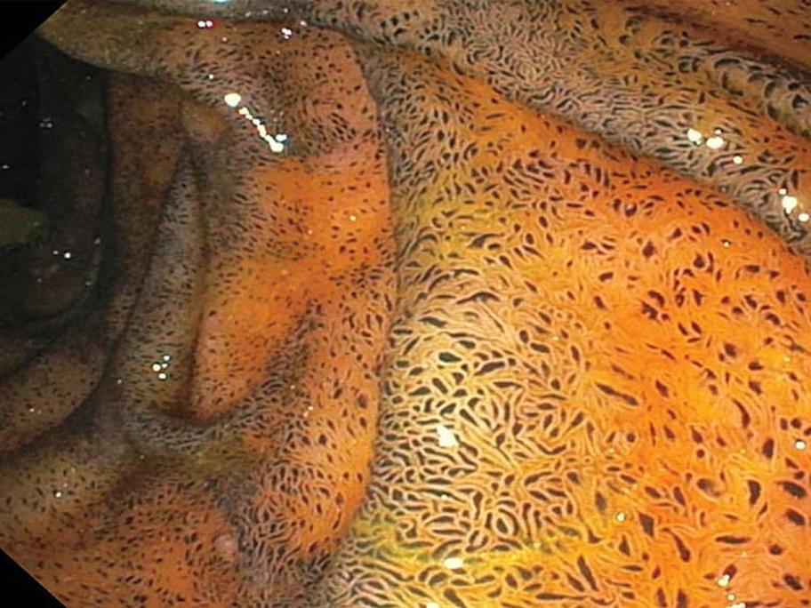 Speckled duodenal mucosa