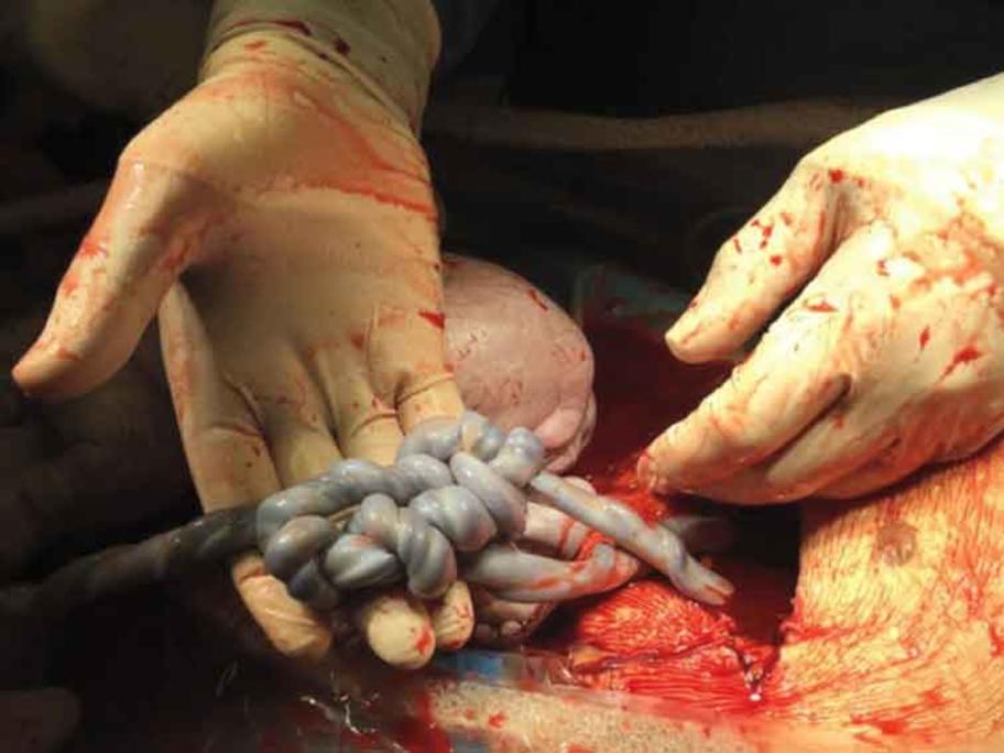Umbilical cords