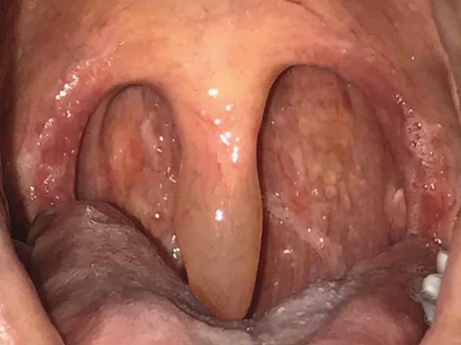 Uvula