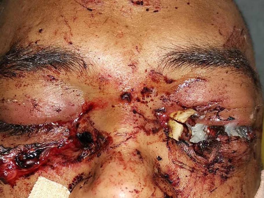 Sugarcane in eye