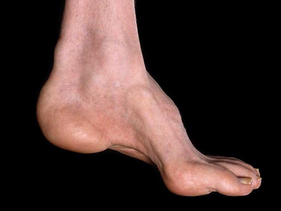 charcot foot