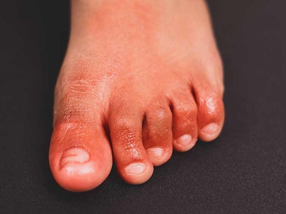 COVID toe