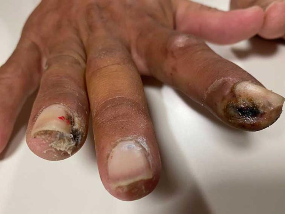 gangrene