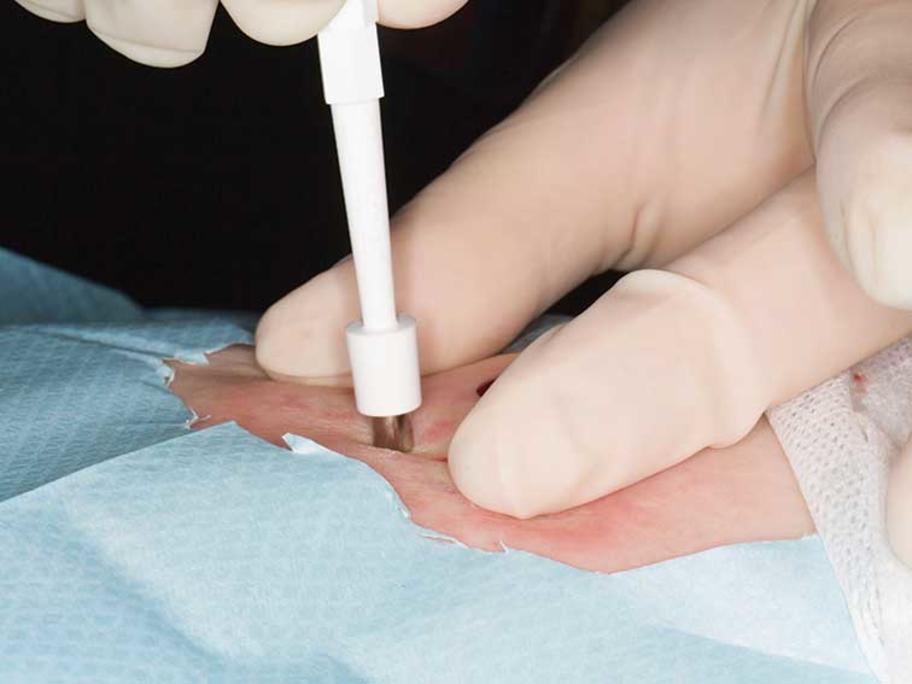 skin punch biopsy