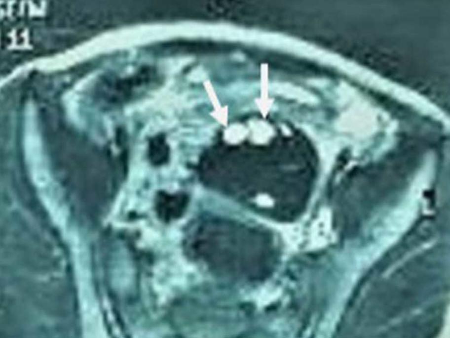 ovarian torsion