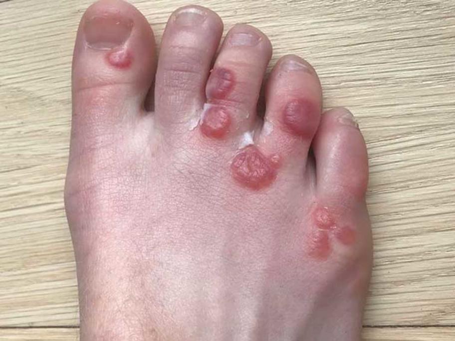toe lesions