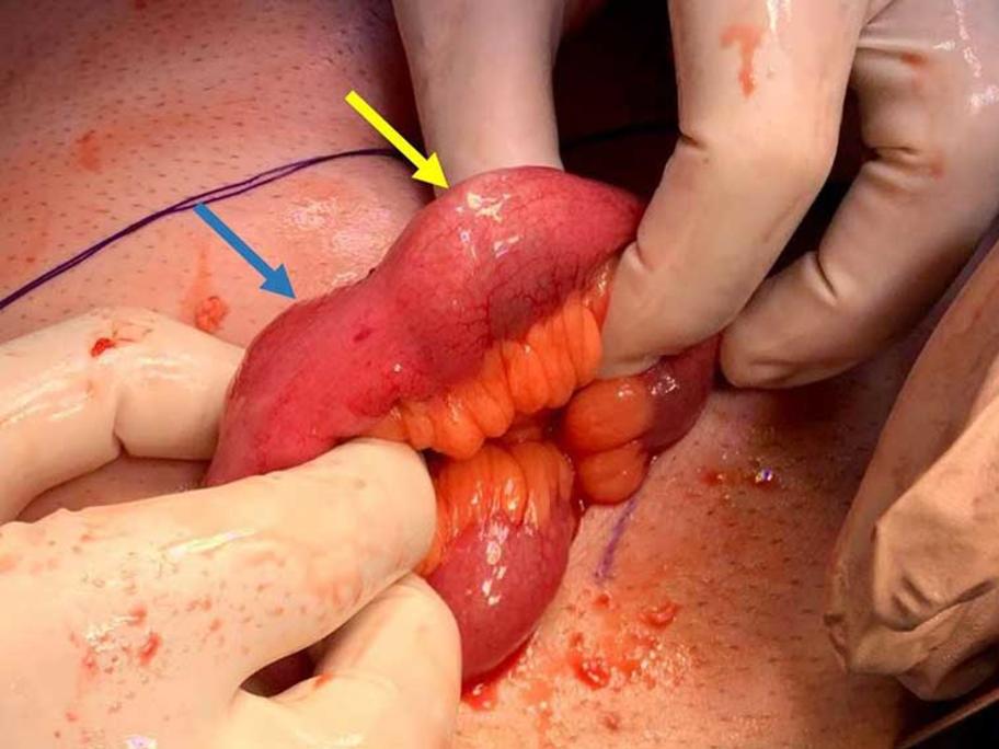 Peach pit impaction