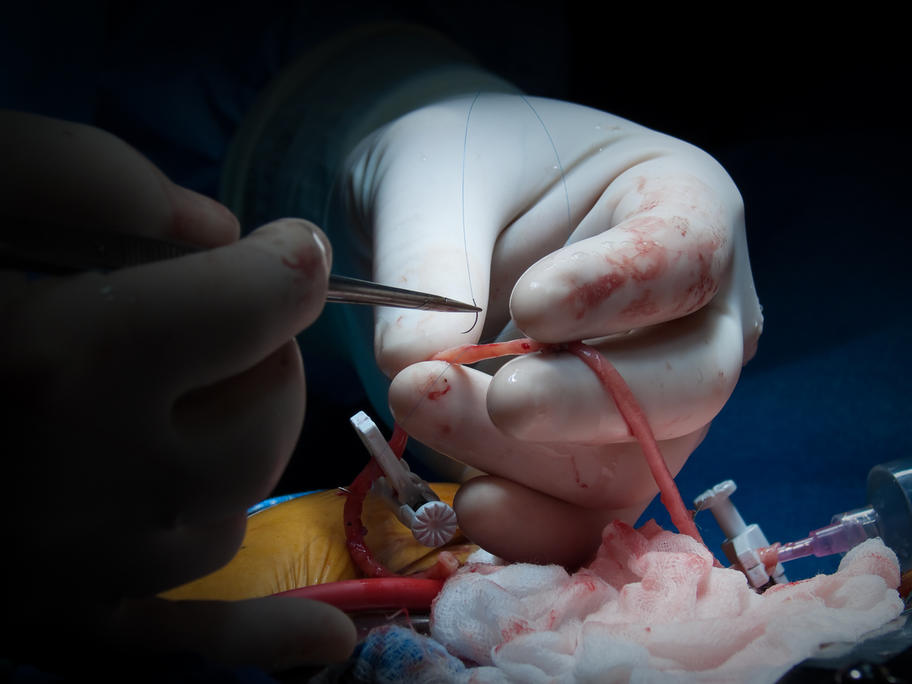 preparing a vein for CABG