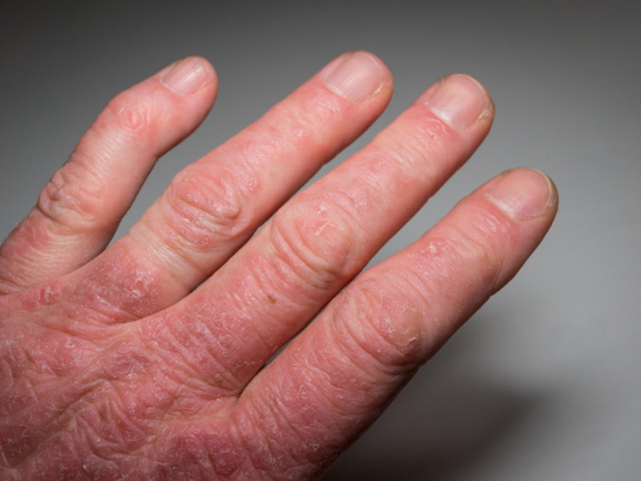 Hand of a patient with psoriasis and psoriatic arthritis