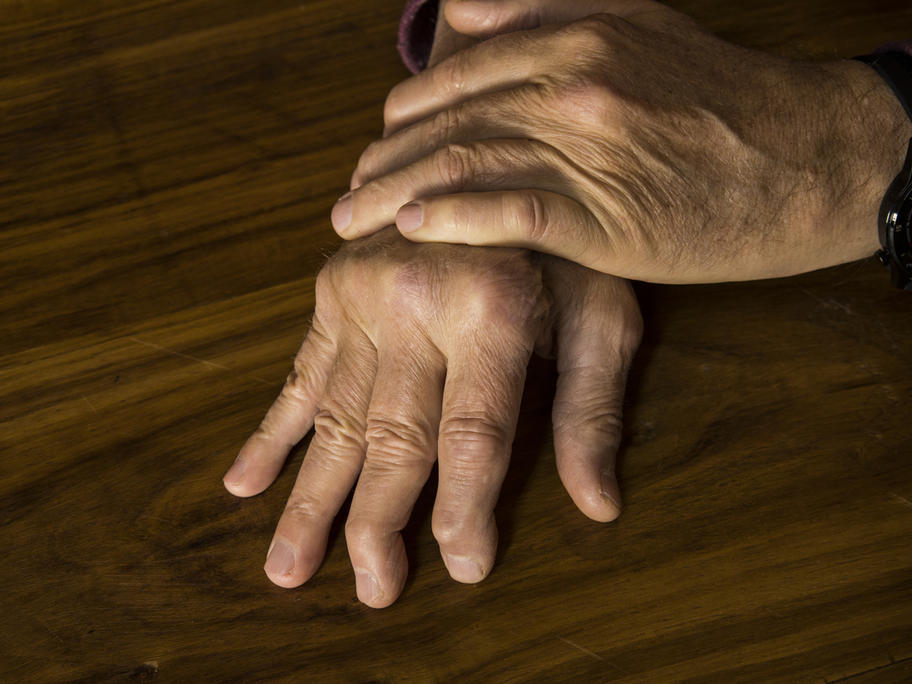 psoriatic arthritis - hands