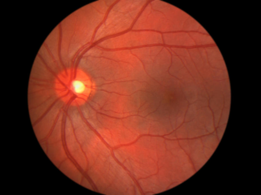 retina