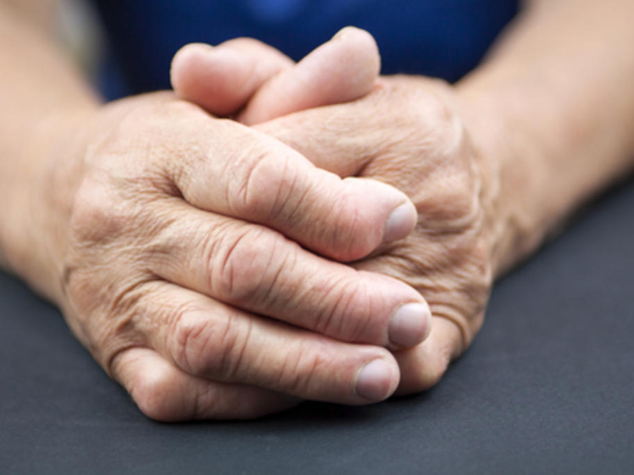 hands with damage from RA