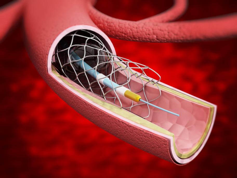 artist's impression of a stent