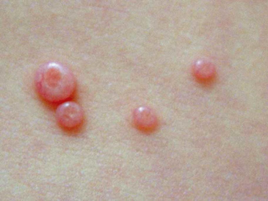 molluscum contagiosum or 'water warts'