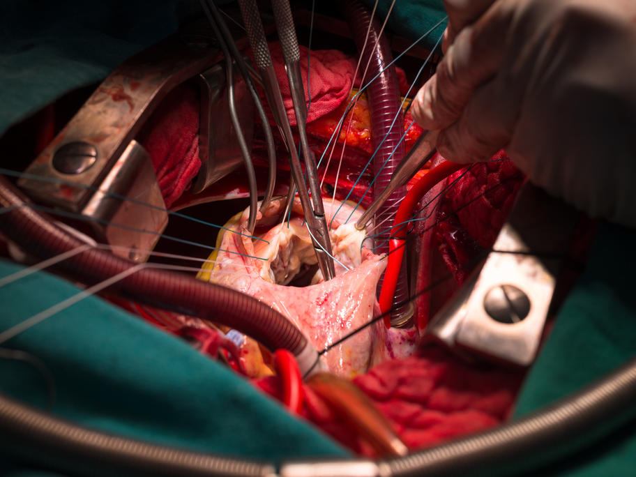 tricuspid valve repair