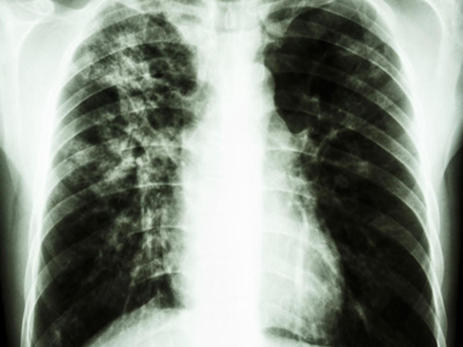 Chest X-ray of a person with TB