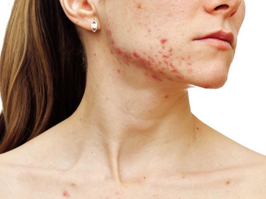 Acne