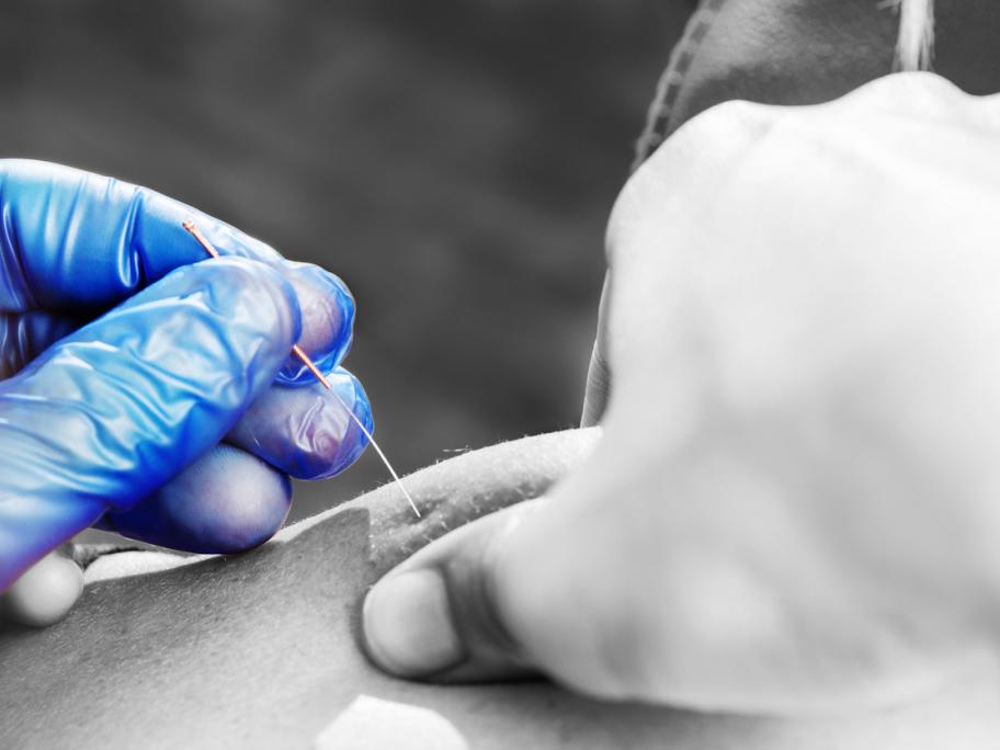 Acupuncture