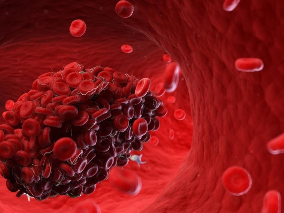 Blood clot