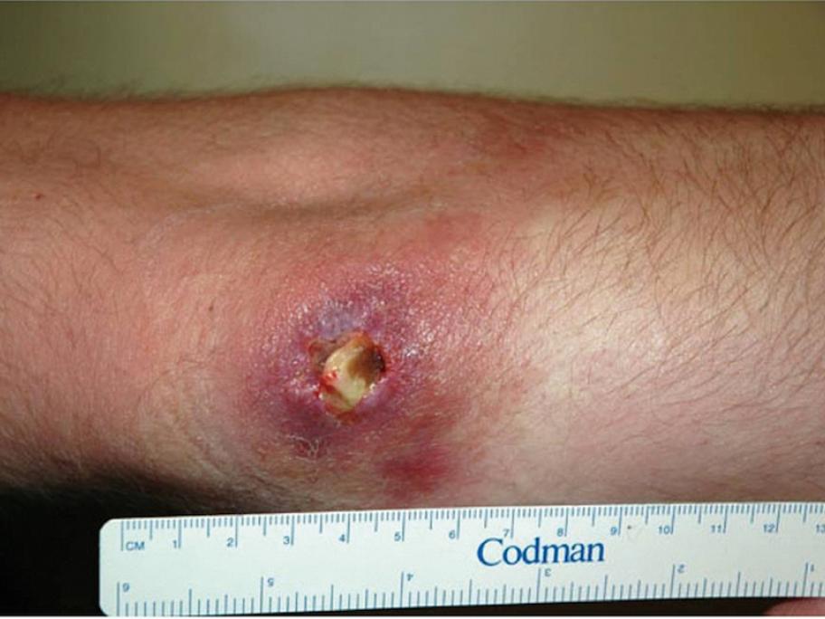 Buruli ulcer
