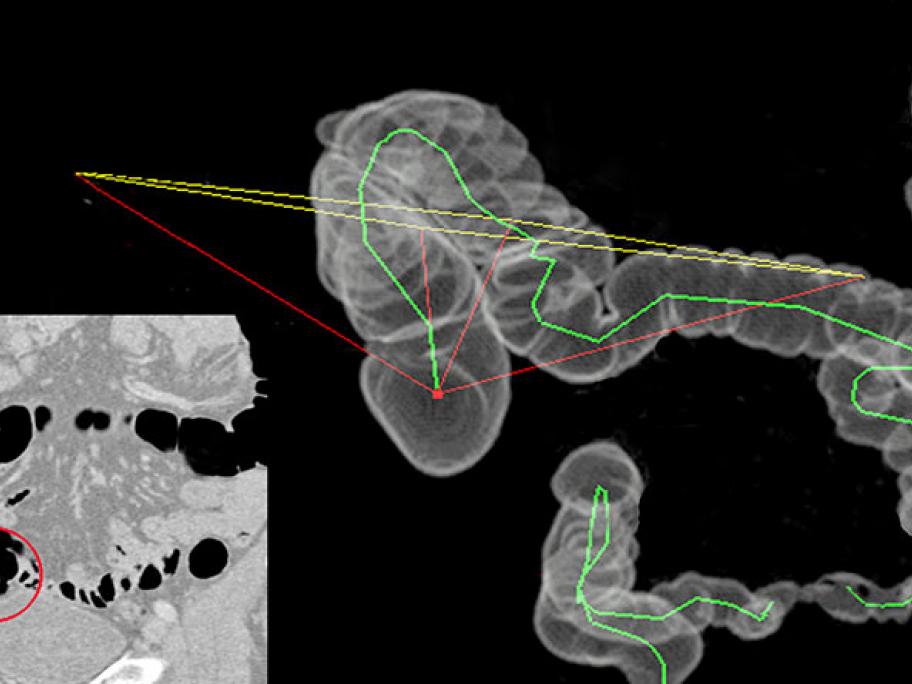 CT colonography