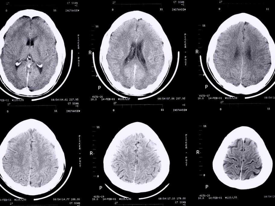 CT brain
