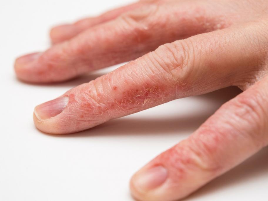 eczema
