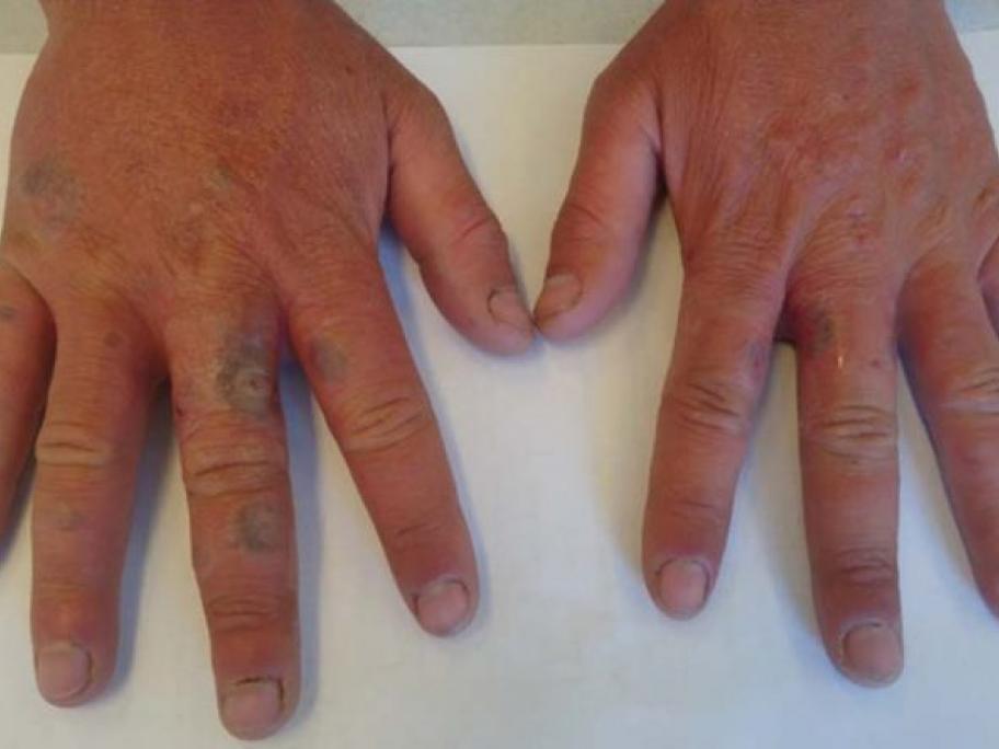 Eruption on hands