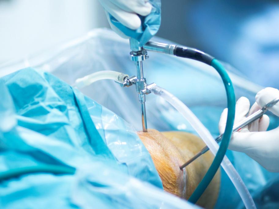 knee arthroscopy