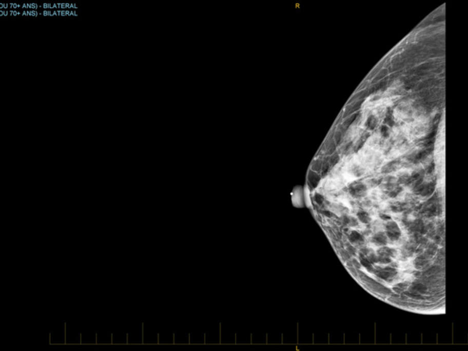 Mammography