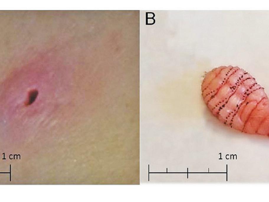 Human botfly larva