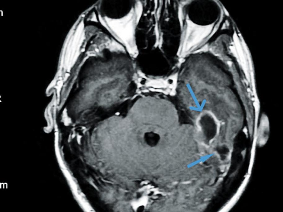 MRI