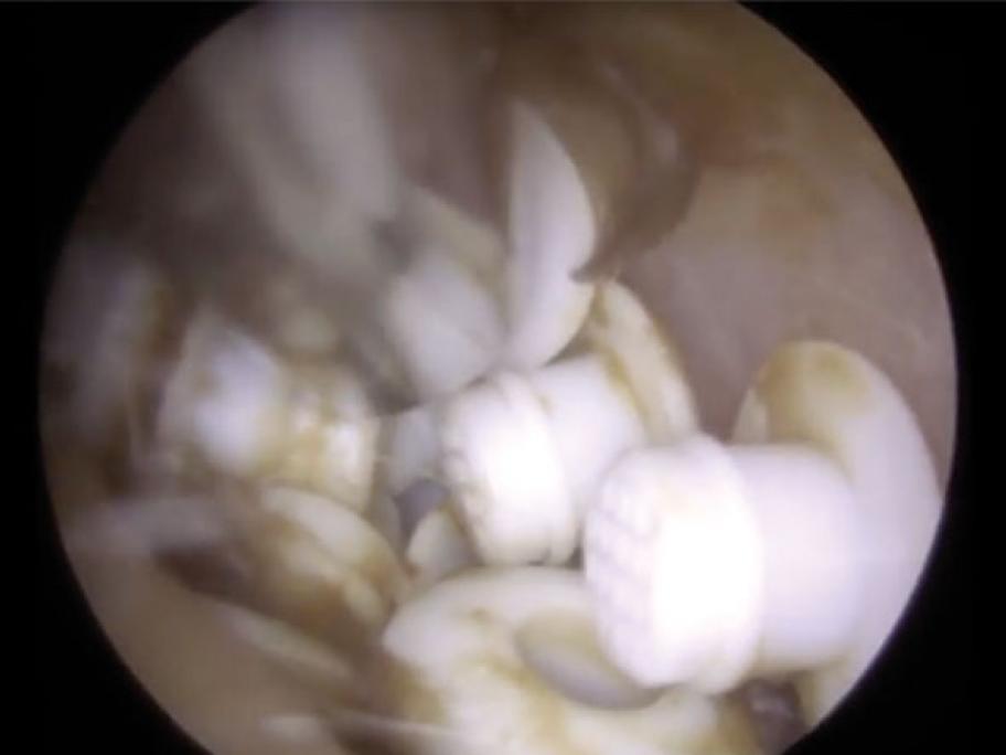 Hearing aid filters