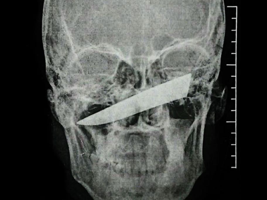 Knife in face