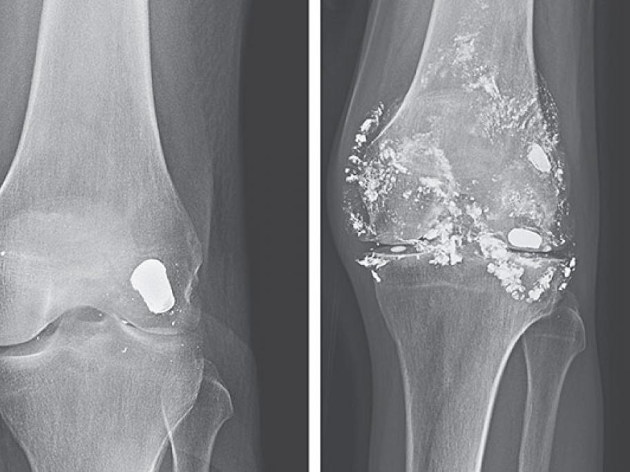 Knee X-ray
