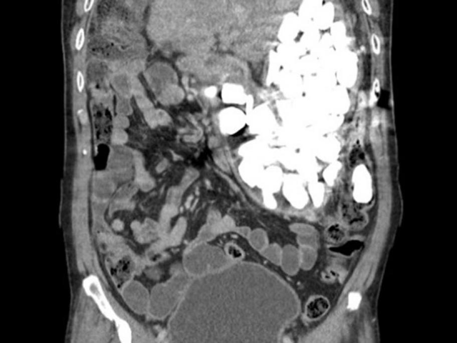 gastric foreign bodies