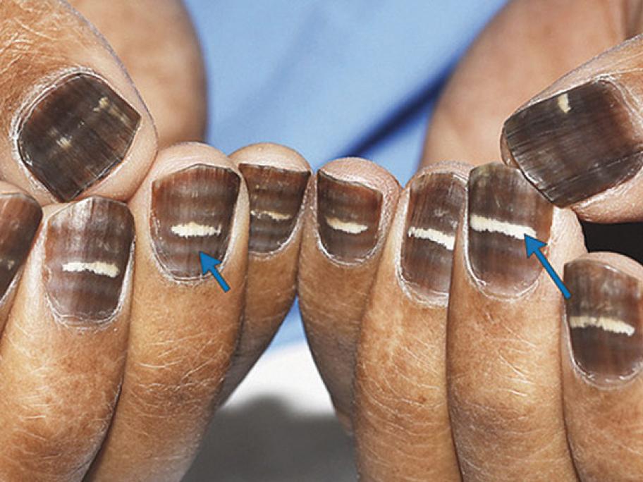 effect of chemotherapy on nails