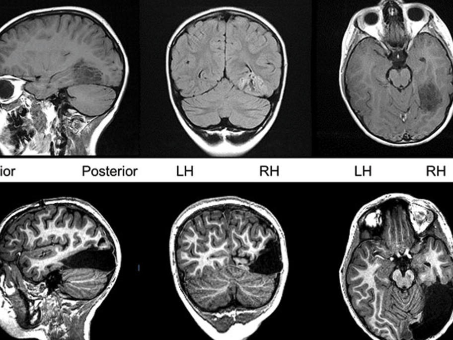 Lobectomy