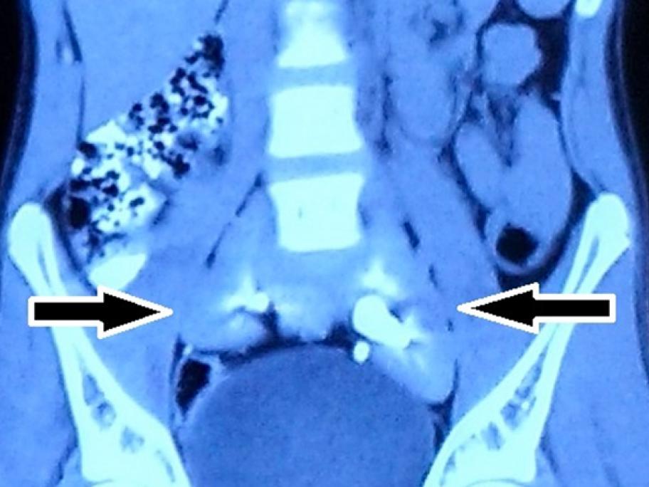 pancake kidney rare disorder