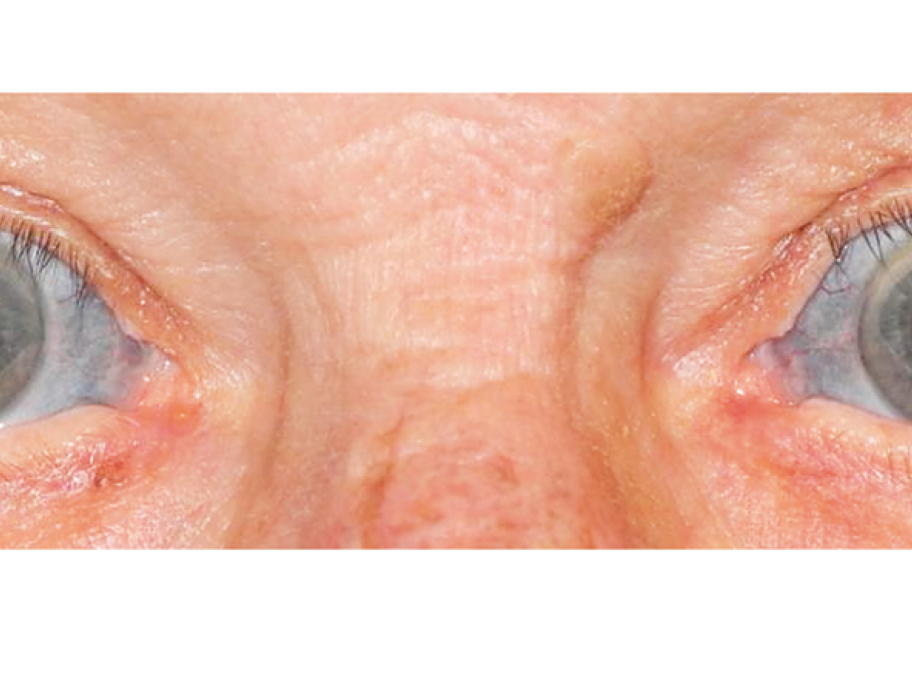 Scleral_discoloration
