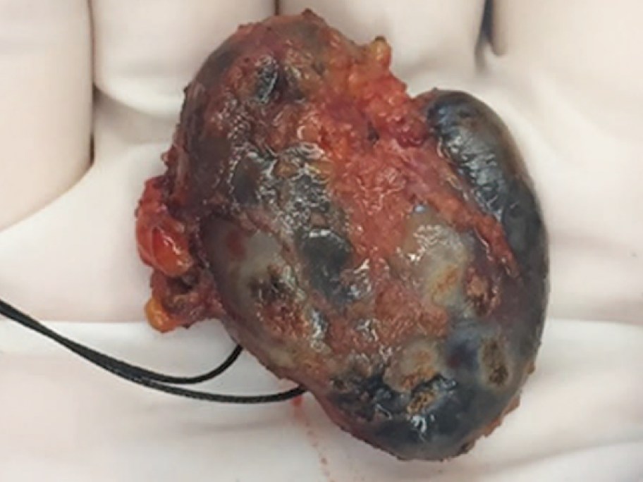Lymphoma
