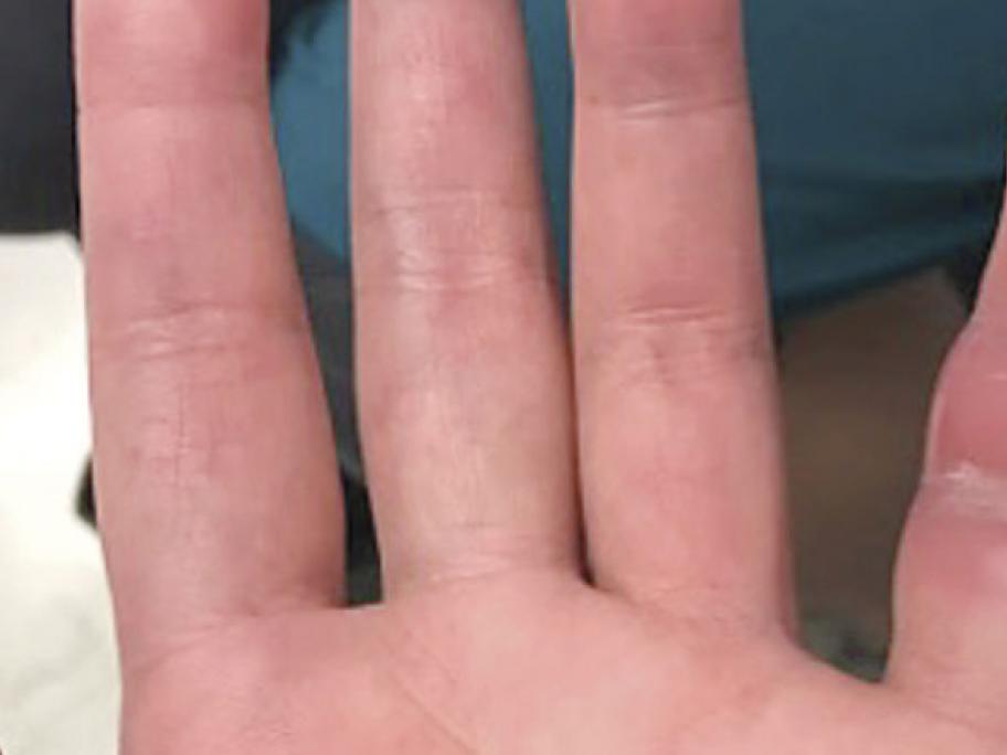 TB of the finger