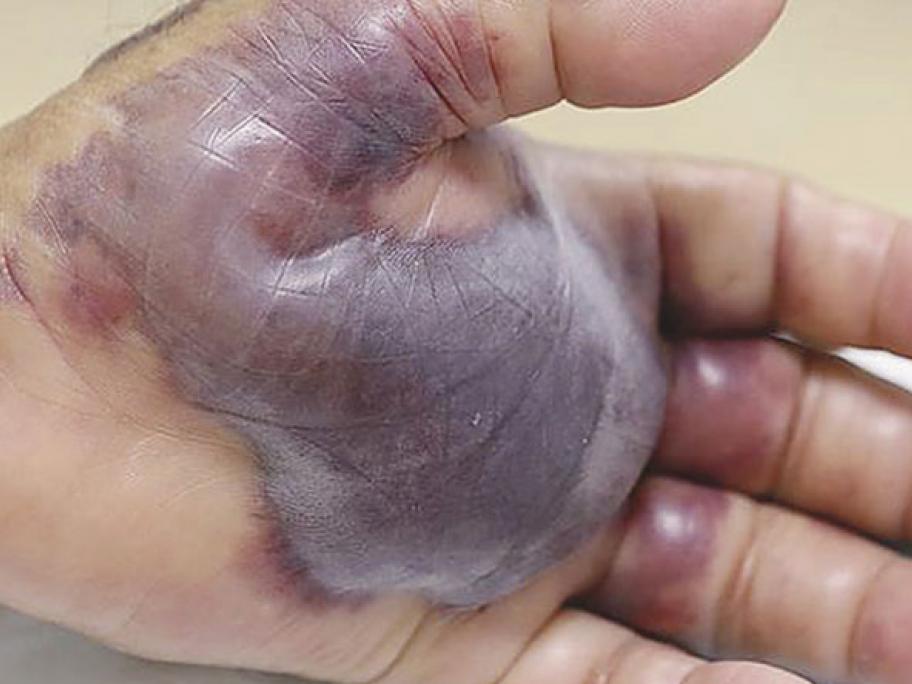 Vibrio vulnificus