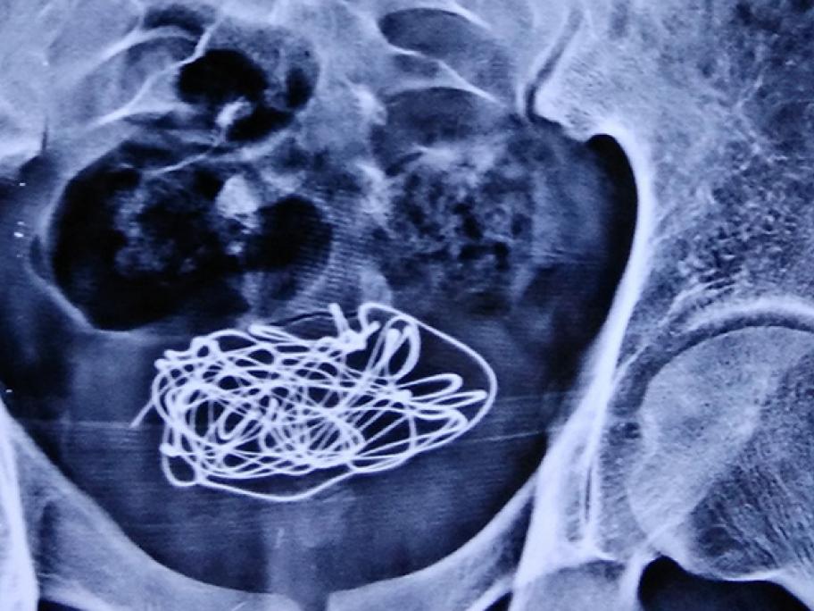 electrical wire in bladder