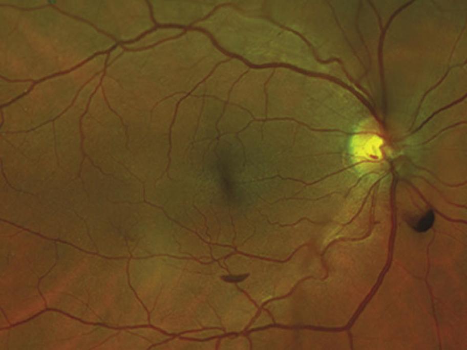 Eye