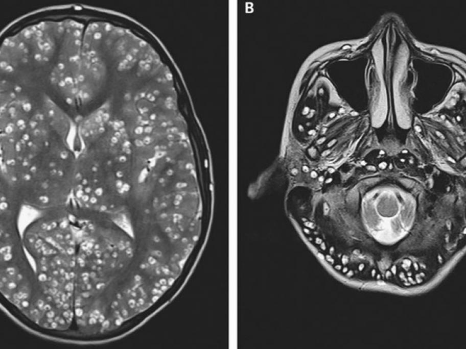 MRI