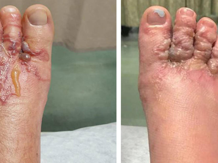 Hookworm_feet