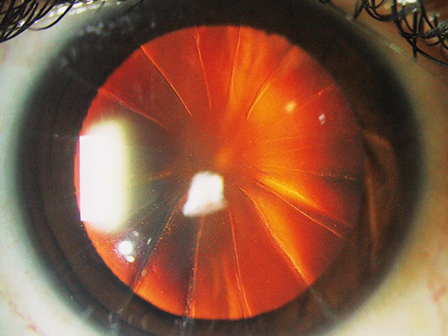 Eye with incisions