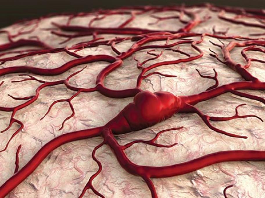Stroke