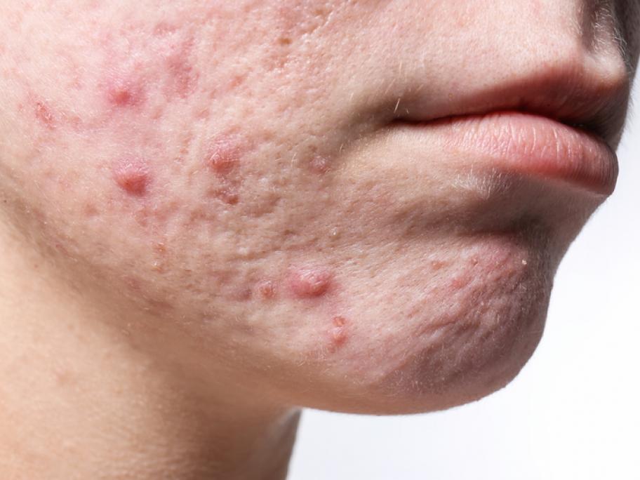 Adolescent face with acne